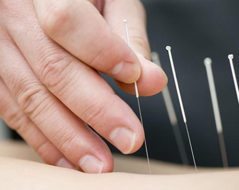 Acupuncture